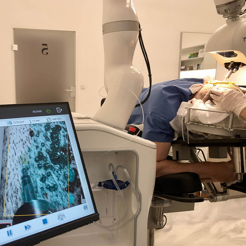 Haartransplantation mit der ARTAS iX-Robotic-FUE-Methode