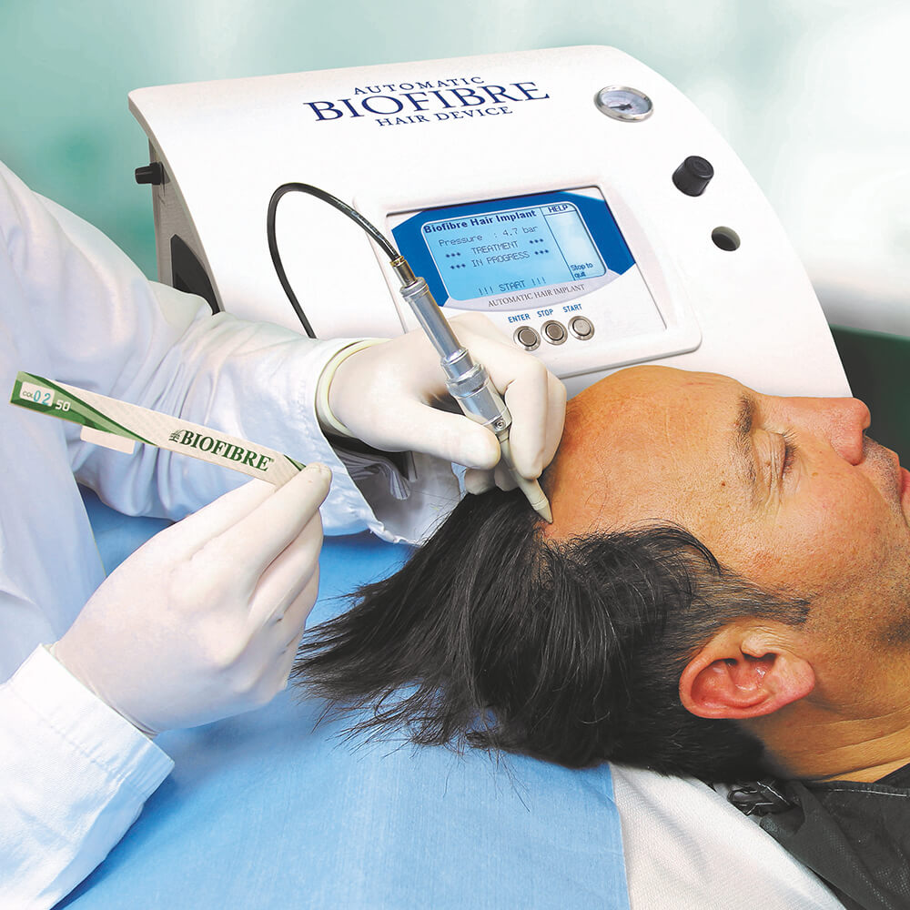 Biofibre: hochwertige Haarnachbildungen per Implantation