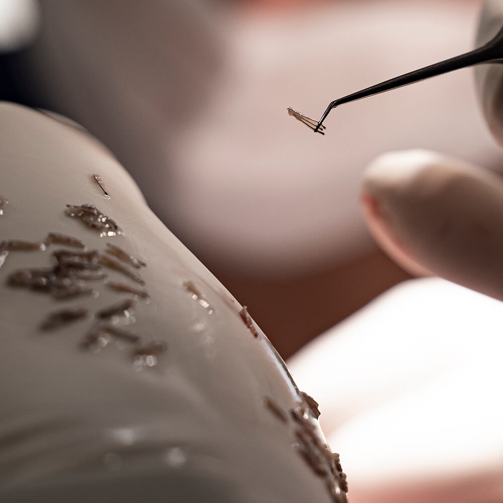 Die manulle FUE-Methode mit PRP und Saphire