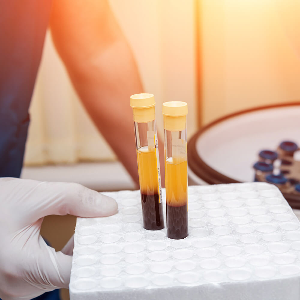 Hochdosierte Blut-Stammzellentherapie gegen Haarausfall